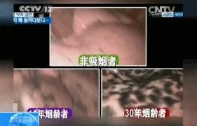 吓人!30年烟龄者的肺黑成这样,看了你还敢吸烟吗?