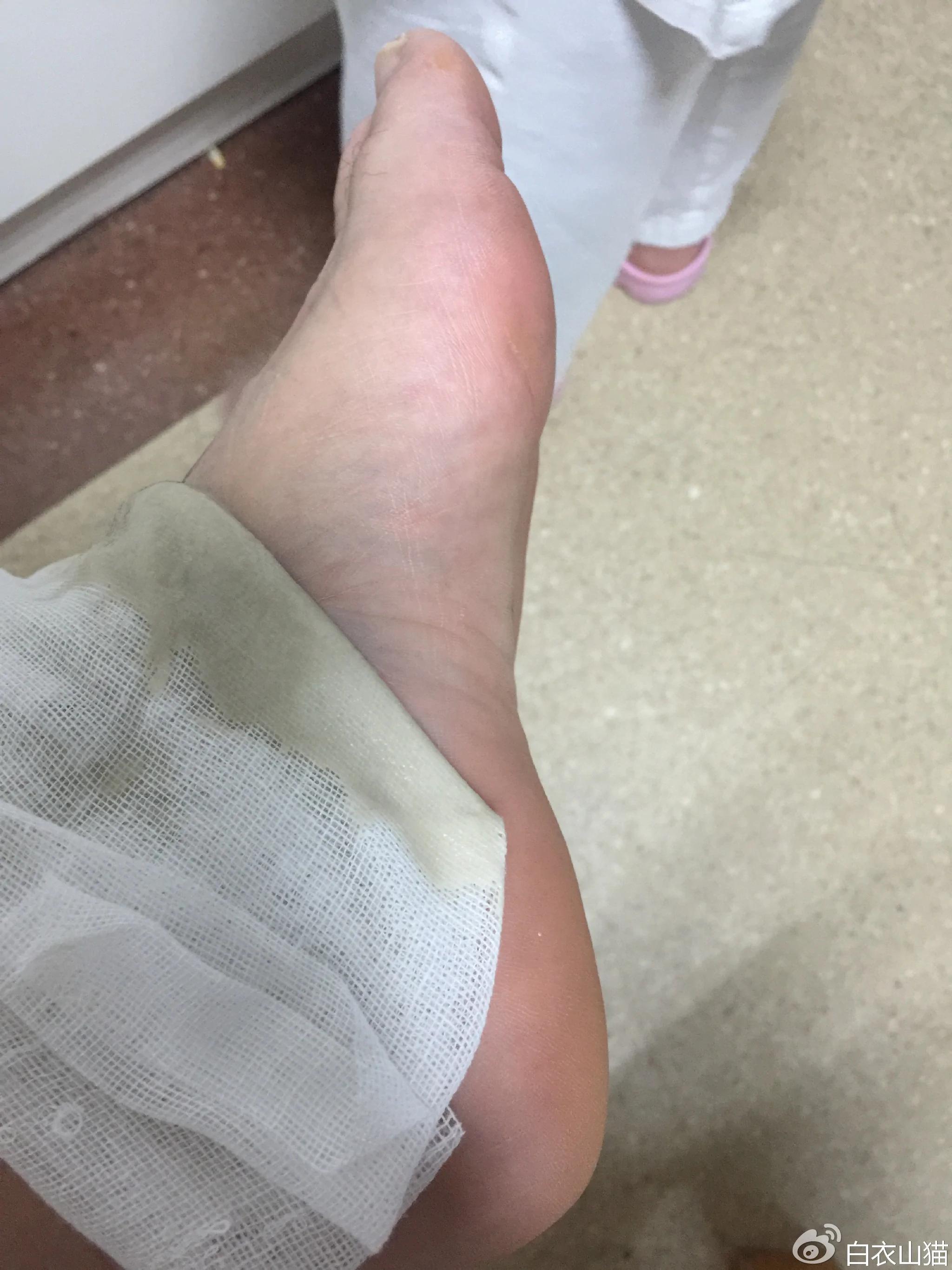 脚扭伤了怎么办?
