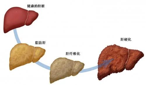 三款近乎失传中药偏方 可击退脂肪肝