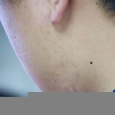 暗瘡皮膚是因為皮脂或污垢阻塞毛孔，細菌繁殖引起的