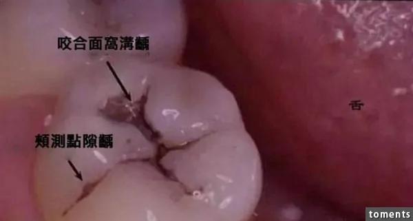 牙齿上出现这种小黑点请注意!如果忽视了后果可能会不堪设想……
