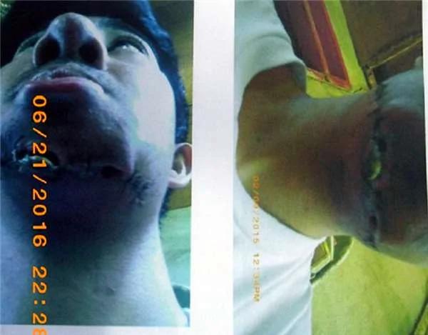 菲律宾小帅哥花了330元超低价整型,结果他用一生来后悔...