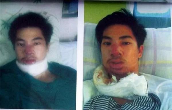 菲律宾小帅哥花了330元超低价整型,结果他用一生来后悔...