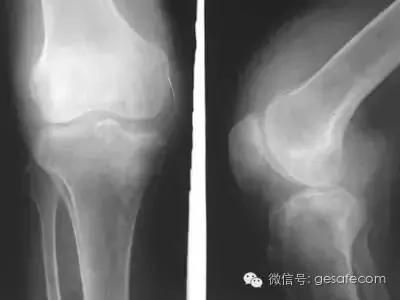日行2万步损了膝盖!每天走多少步最健康?