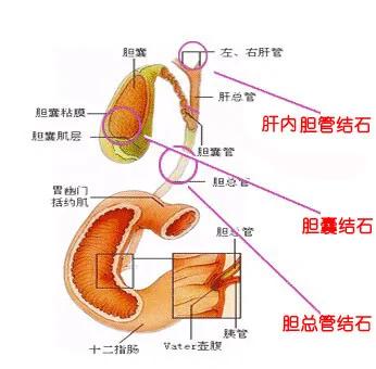 为什么吃早饭可以预防胆结石化!!!