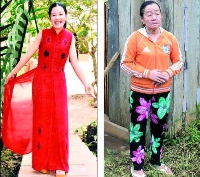 26岁美女一夜衰老成90岁老太