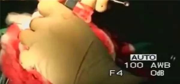 “吃脑寄生虫”侵袭陆女脑内 切开后居然看到巨型囊肿…… 太可怕了!