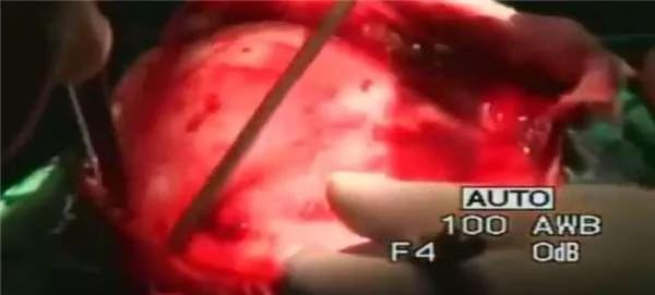 “吃脑寄生虫”侵袭陆女脑内 切开后居然看到巨型囊肿…… 太可怕了！