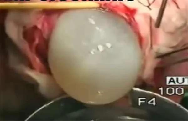 “吃脑寄生虫”侵袭陆女脑内 切开后居然看到巨型囊肿…… 太可怕了!