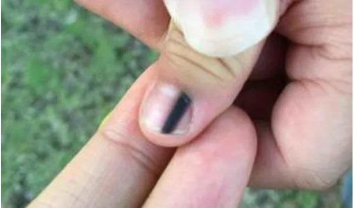 指甲上长出一条黑色条纹 不疼不痒 这是怎么回事儿?图集