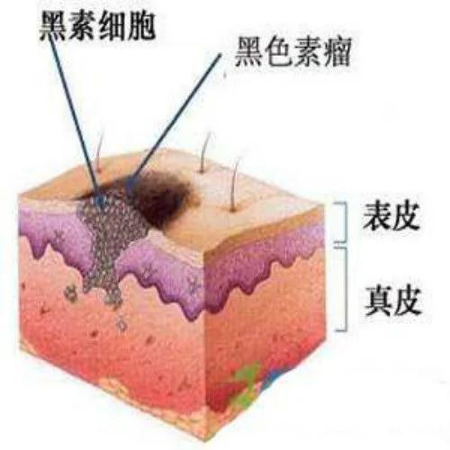 指甲上长出一条黑色条纹 不疼不痒 这是怎么回事儿?图集