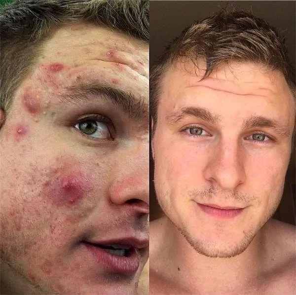 健身猛男分享了他的抗痘经验谈 要让烂脸变成光滑肌肤可从这些日常习惯下手!