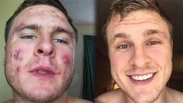 健身猛男分享了他的抗痘经验谈 要让烂脸变成光滑肌肤可从这些日常习惯下手!
