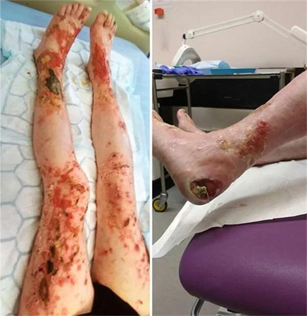 爱犬舍不得主人受伤而上前舔拭 结果这个温馨的举动竟危及饲主生命!