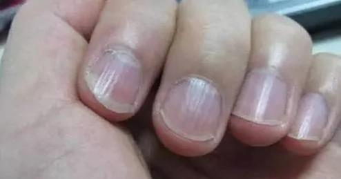 警惕!指甲上出现这些竖纹竟是大病预兆!不看会后悔!