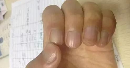 警惕!指甲上出现这些竖纹竟是大病预兆!不看会后悔!