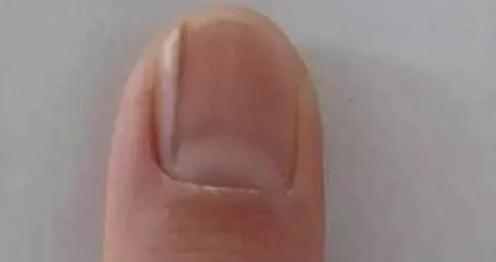 警惕!指甲上出现这些竖纹竟是大病预兆!不看会后悔!