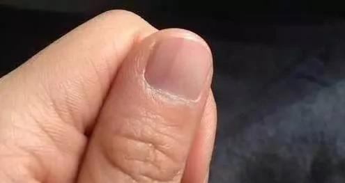 警惕!指甲上出现这些竖纹竟是大病预兆!不看会后悔!