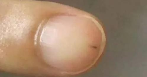 警惕!指甲上出现这些竖纹竟是大病预兆!不看会后悔!