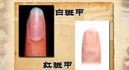 警惕!指甲上出现这些竖纹竟是大病预兆!不看会后悔!