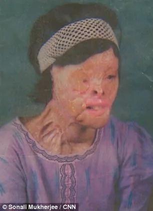 17岁印度美女拒绝性侵被报复“硫酸泼脸毁容” 手术后活出奇迹得到完美的生活!