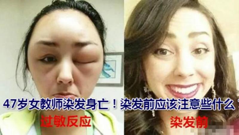 47岁女教师染发身亡!染发前应该注意些什么?