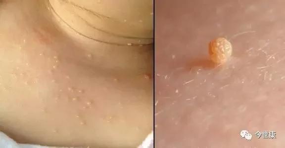 脖子上的小肉粒是怎么回事?