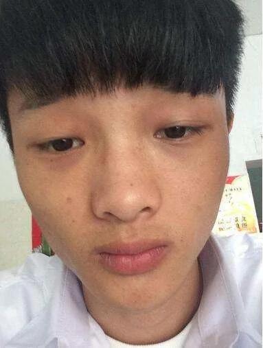 肝脏是否健康 看你的脸就知道