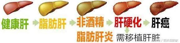 为什么肝癌发现都是晚期?警惕这个信号 早发现早预防