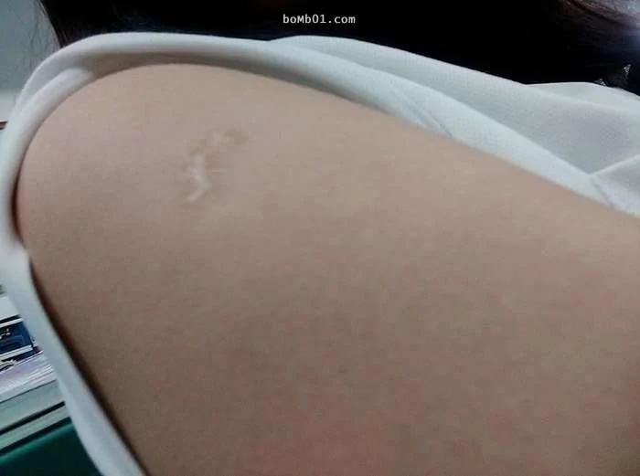 快检查看看手臂上有没有“卡介苗疤” 如果没有的话你就是超稀少的幸运儿体质!