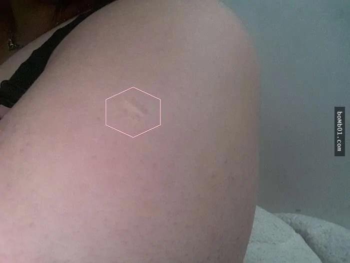 快检查看看手臂上有没有“卡介苗疤” 如果没有的话你就是超稀少的幸运儿体质!