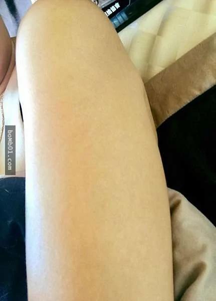 快检查看看手臂上有没有“卡介苗疤” 如果没有的话你就是超稀少的幸运儿体质!