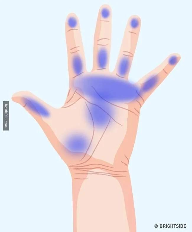 7种“手痛的感觉”代表身体已经在发出健康警讯