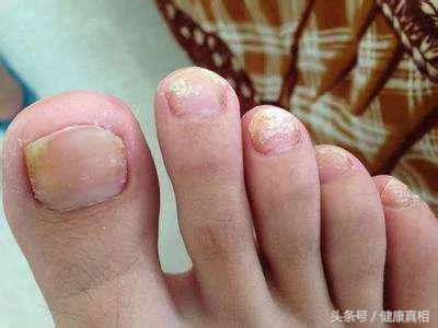 脚的各种症状 预示着身体的变化