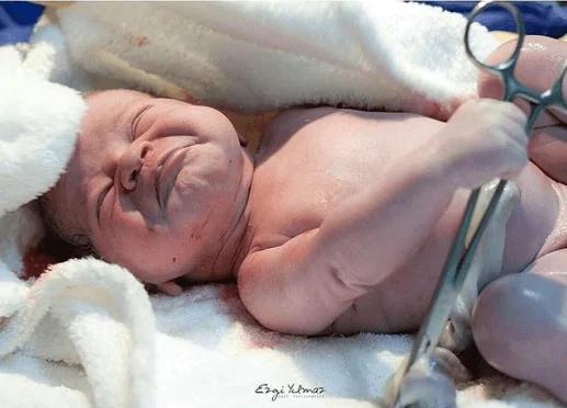 刚剖腹婴儿手抓住医生的剪刀不让剪脐带