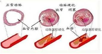 腿发冷、麻木需警惕 很可能是“腿梗” 早期症状别忽视!