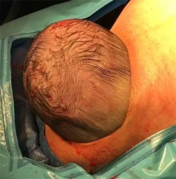 医生朝产妇的肚子上划开一个小切口后 婴儿迫不及待了…
