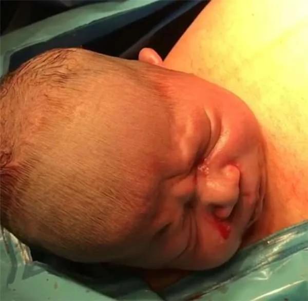 医生朝产妇的肚子上划开一个小切口后 婴儿迫不及待了…