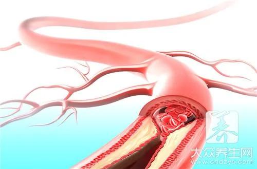 六个细节打造健康血管 年轻人更该学