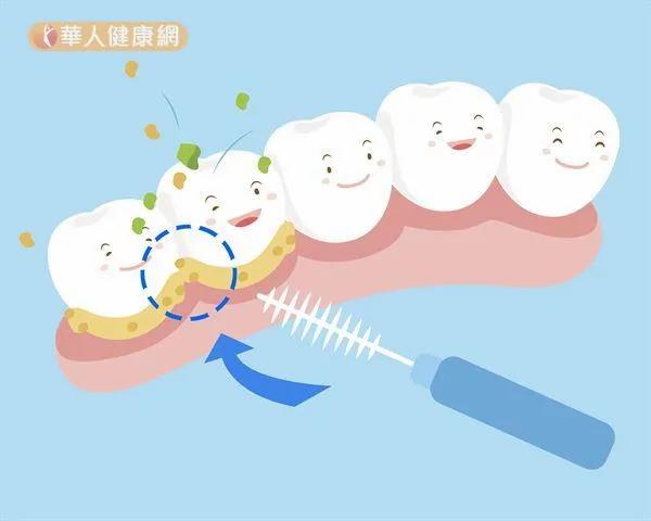 口腔清洁只靠刷牙太天真 善用牙间刷、牙线棒护牙一把罩