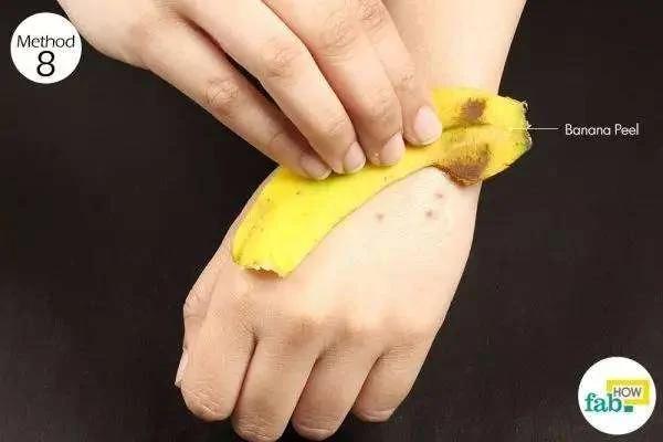 被蚊子咬后皮肤越抓越痒 教你个止痒绝招 只需10秒钟止痒不留印痕