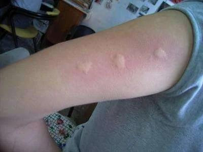 被蚊子咬后皮肤越抓越痒 教你个止痒绝招 只需10秒钟止痒不留印痕