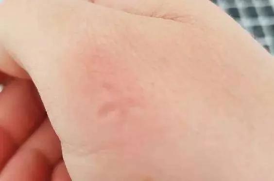 被蚊子咬后皮肤越抓越痒 教你个止痒绝招 只需10秒钟止痒不留印痕