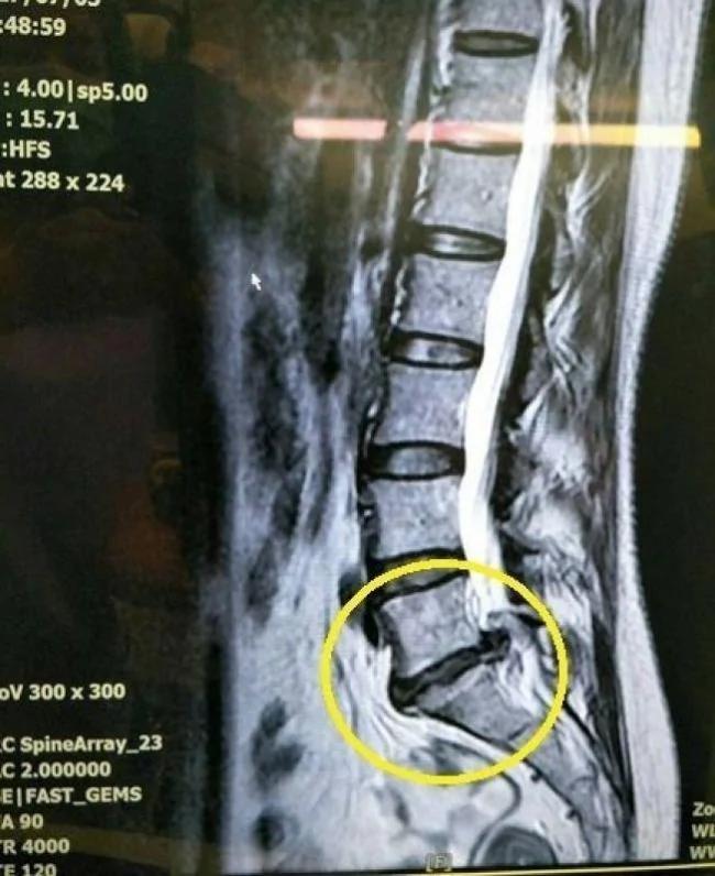 听过椎间盘突出 看过椎间盘爆掉吗?
