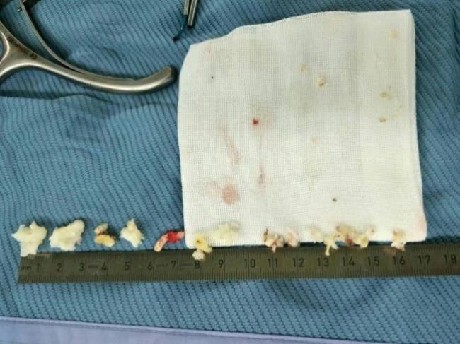 听过椎间盘突出 看过椎间盘爆掉吗?
