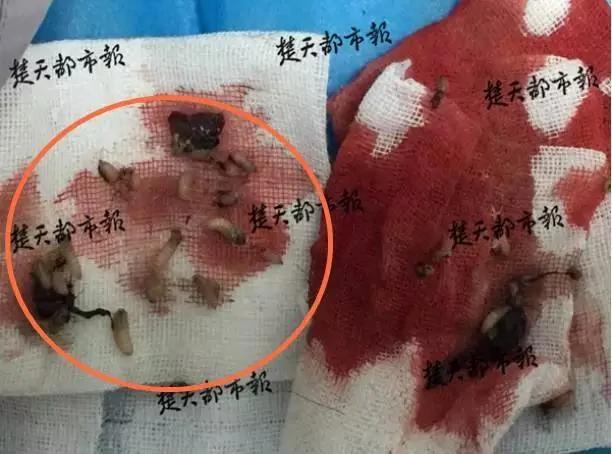 男子后脑勺长50条蛆 竟是因为一个动作