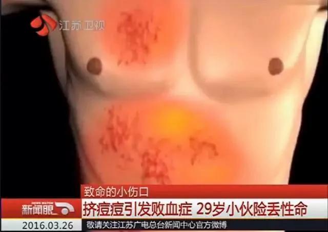 男子后脑勺长50条蛆 竟是因为一个动作