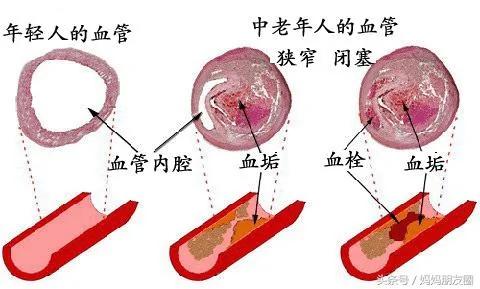 豆豉是化血栓第一豆!预防冠心病老年痴呆轻轻松松吃出来