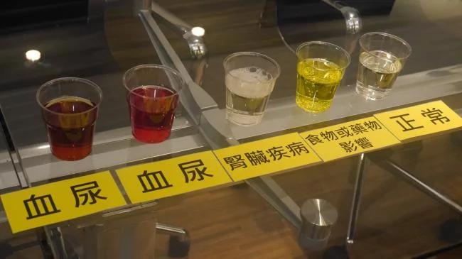小便是这个颜色的 当心是癌症