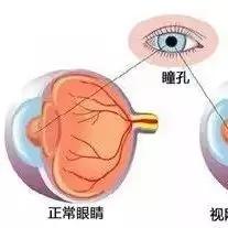 糖尿病人最容易并发眼底病!该多久查、怎么查?这里都有方法!